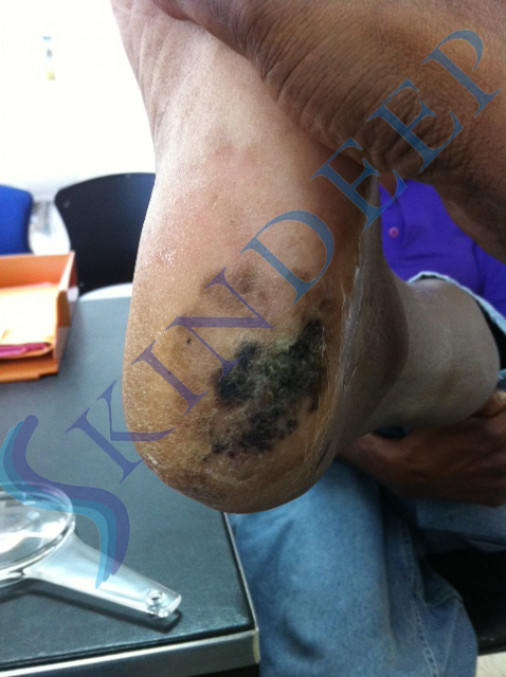 Acral Malignant Melanoma 1