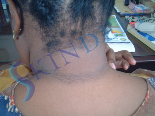 Acanthosis Nigricans