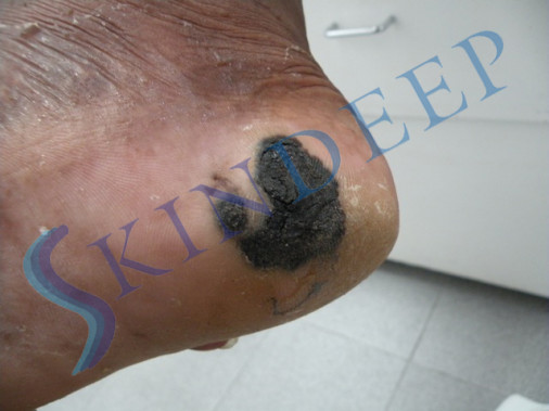 Acral Malignant Melanoma