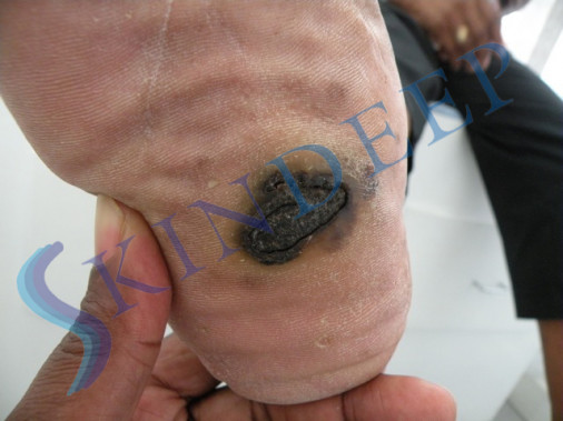 Acral Malignant Melanoma 2