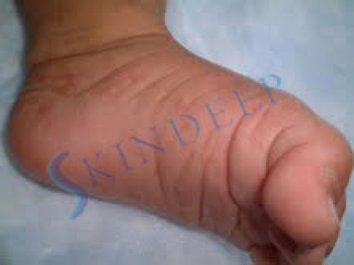 Acropustulosis of Infancy 1