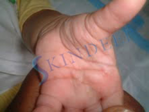 Acropustulosis of Infancy 2