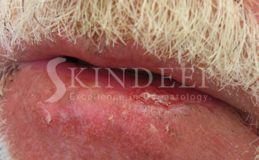 Actinic Chelitis