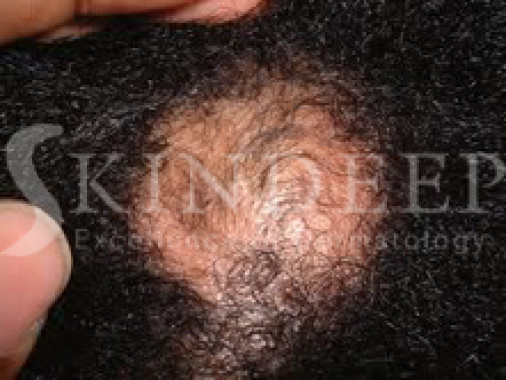 Alopecia Areata 1