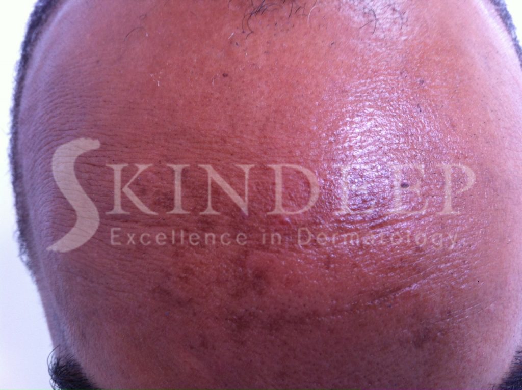 Lateral Cheek Pattern MELASMA – Skindeep Barbados