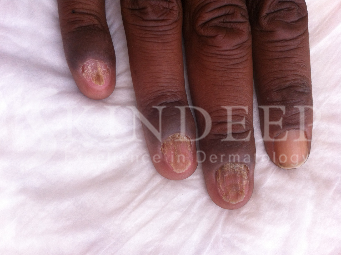 Candidiasis of a fingernail - Stock Image - C047/0371 - Science Photo  Library
