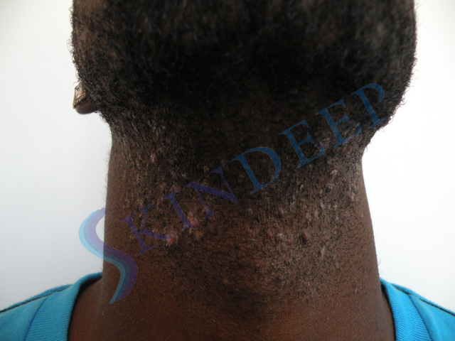 PSEUDOFOLLICULITIS BARBAE (PFB) – Skindeep Barbados